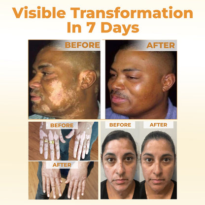 Cvreoz® VitiGone Rapid Spray — 2 Week Repigmentation with OTDS