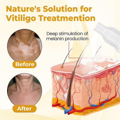 ⏰Last Day Promotion: 60% OFF Only This Week!🔥 Crveoz® Evenora Vitiligo Herbal Spray