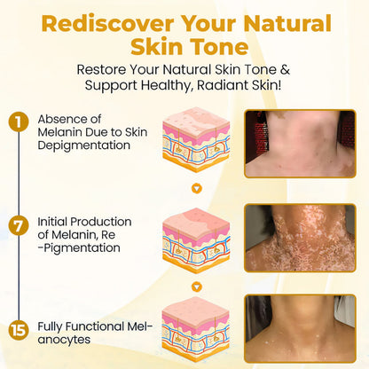 ⏰Last Day Promotion: 60% OFF Only This Week!🔥 Crveoz® Evenora Vitiligo Herbal Spray