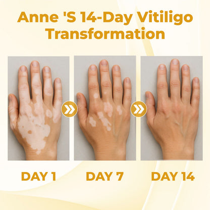 ⏰Last Day Promotion: 60% OFF Only This Week!🔥 Crveoz® Evenora Vitiligo Herbal Spray