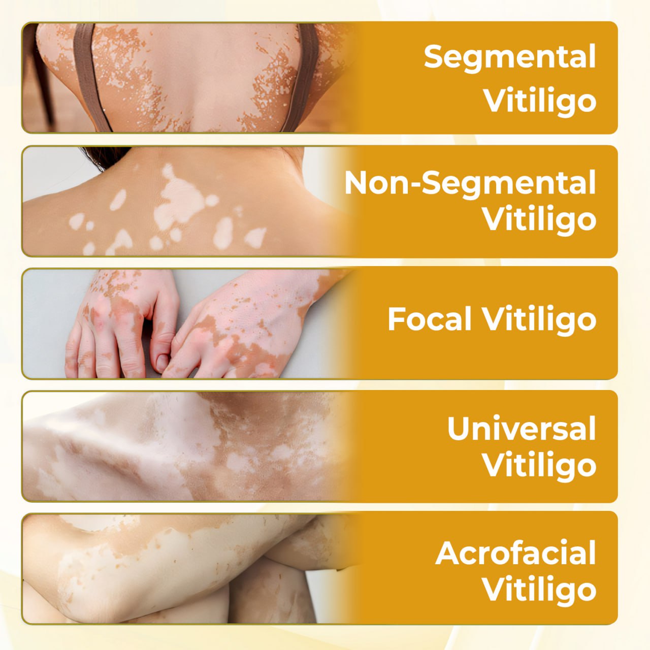 ⏰Last Day Promotion: 60% OFF Only This Week!🔥 Crveoz® Evenora Vitiligo Herbal Spray