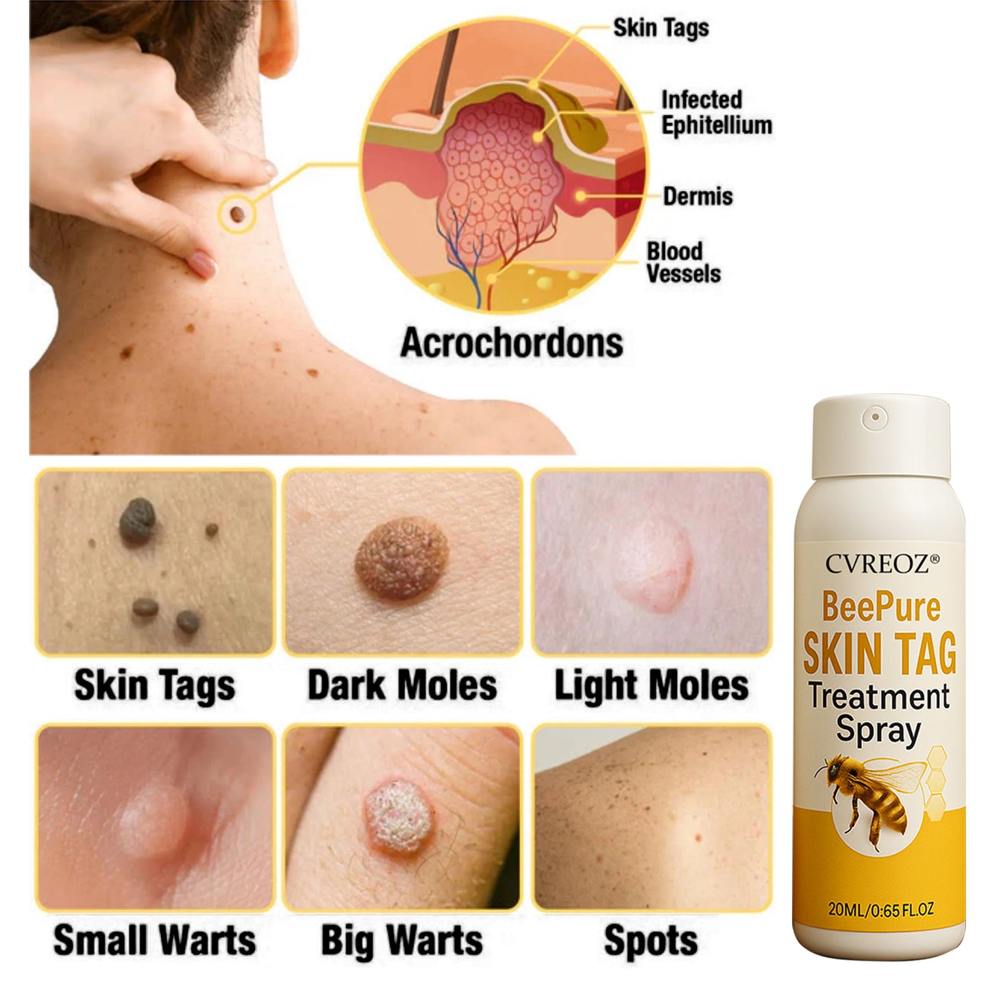 🎉SPECIAL OFFER: 60% OFF This Week Only!🔥 Cvreoz® BeePure Skin Tag Treatment Spray