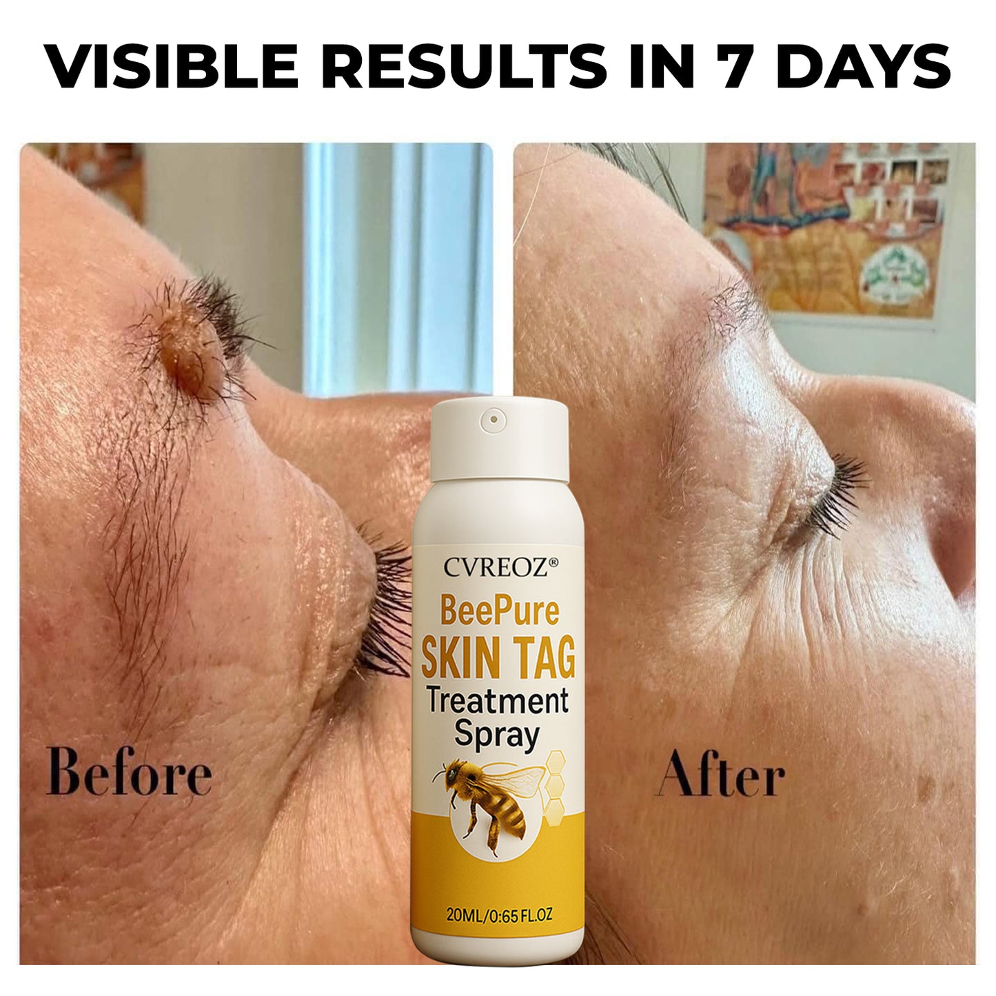 🎉SPECIAL OFFER: 60% OFF This Week Only!🔥 Cvreoz® BeePure Skin Tag Treatment Spray