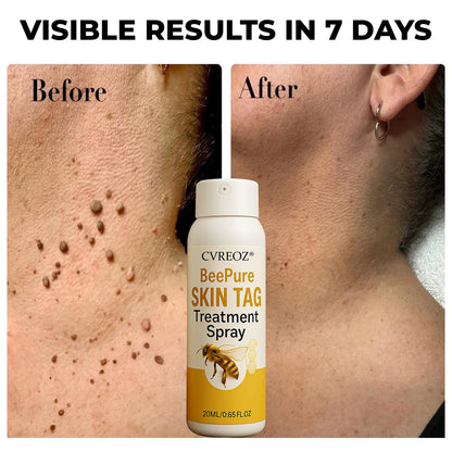 🎉SPECIAL OFFER: 60% OFF This Week Only!🔥 Cvreoz® BeePure Skin Tag Treatment Spray